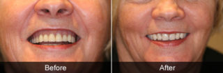 Before and after facelift denture