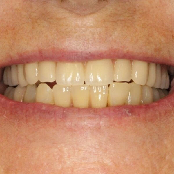 Acrylic partial denture
